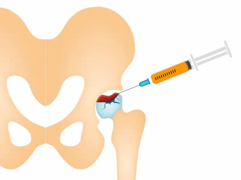 Advanced AVN Hip Treatment