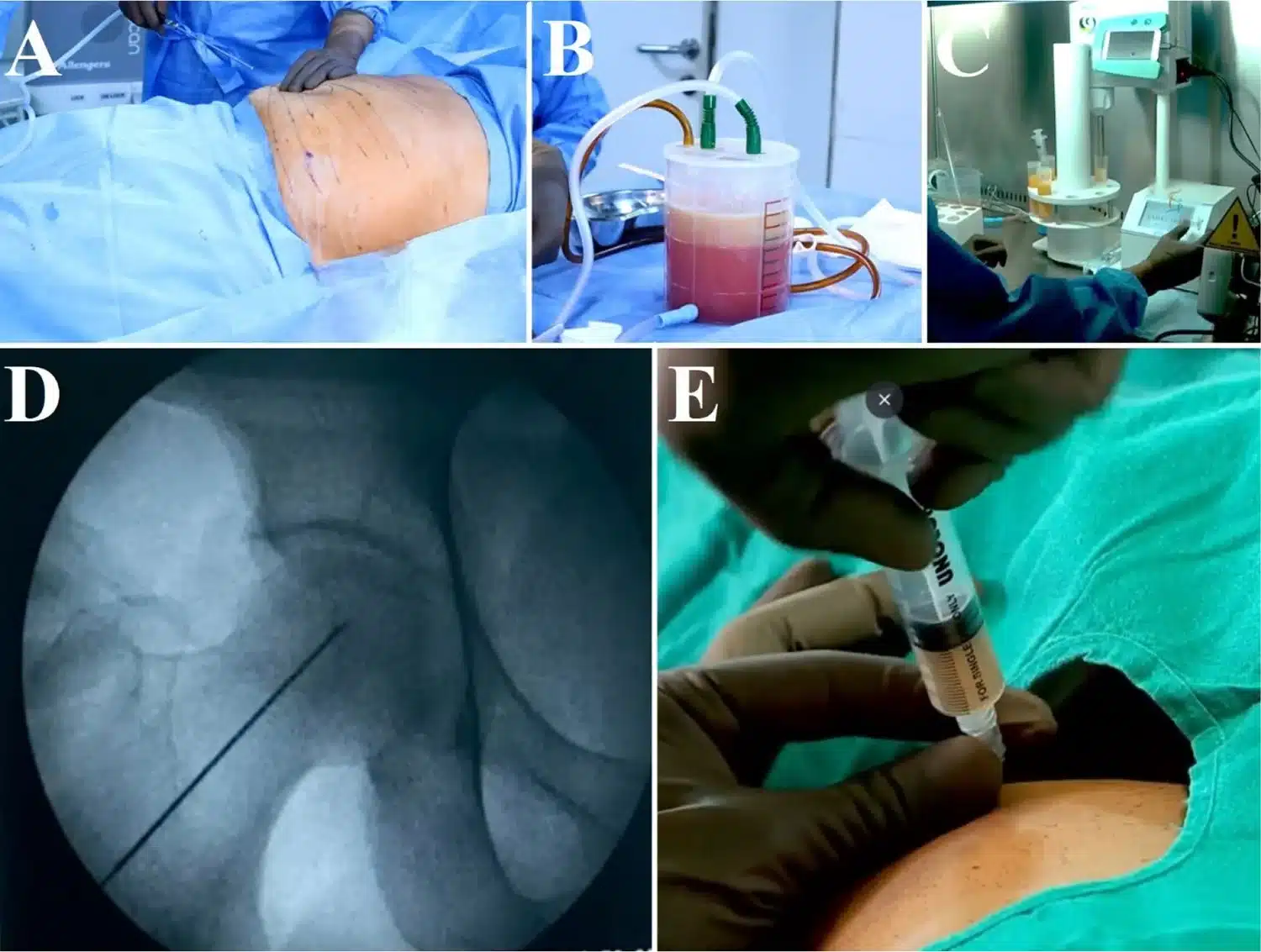 Hip AVN SVF Procedure