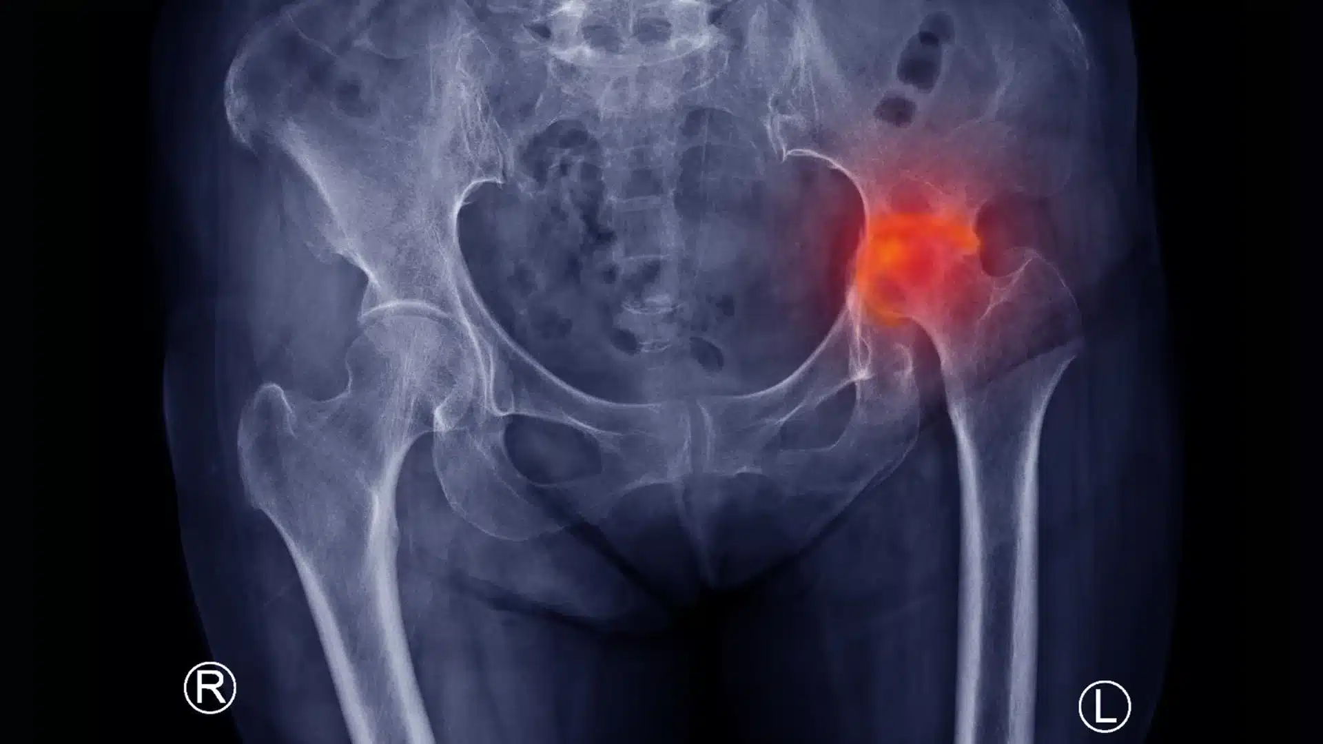 osteonecrosis hip pain treatment india