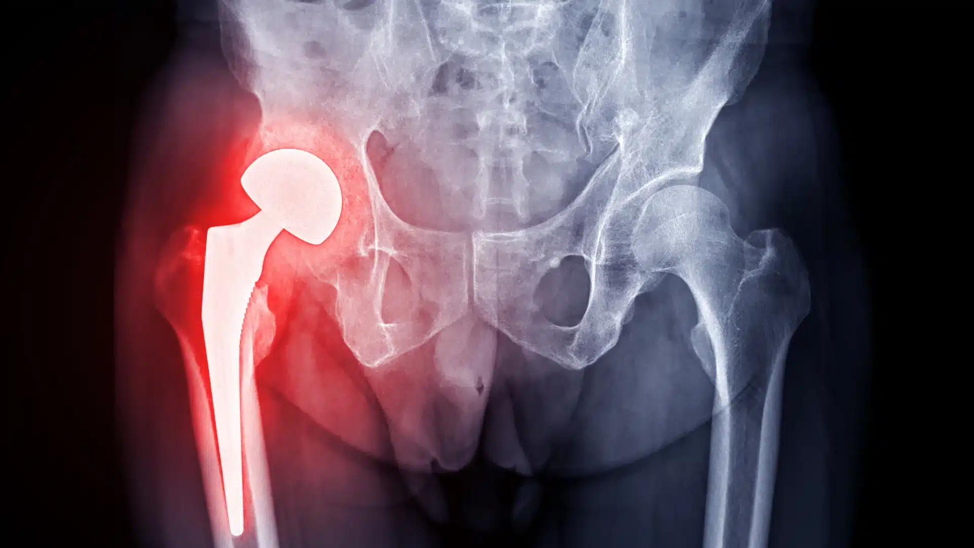 Hip Replacement Surgery