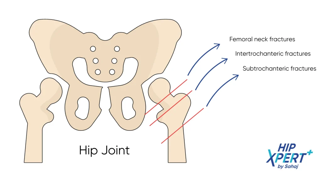 types of hip fractures