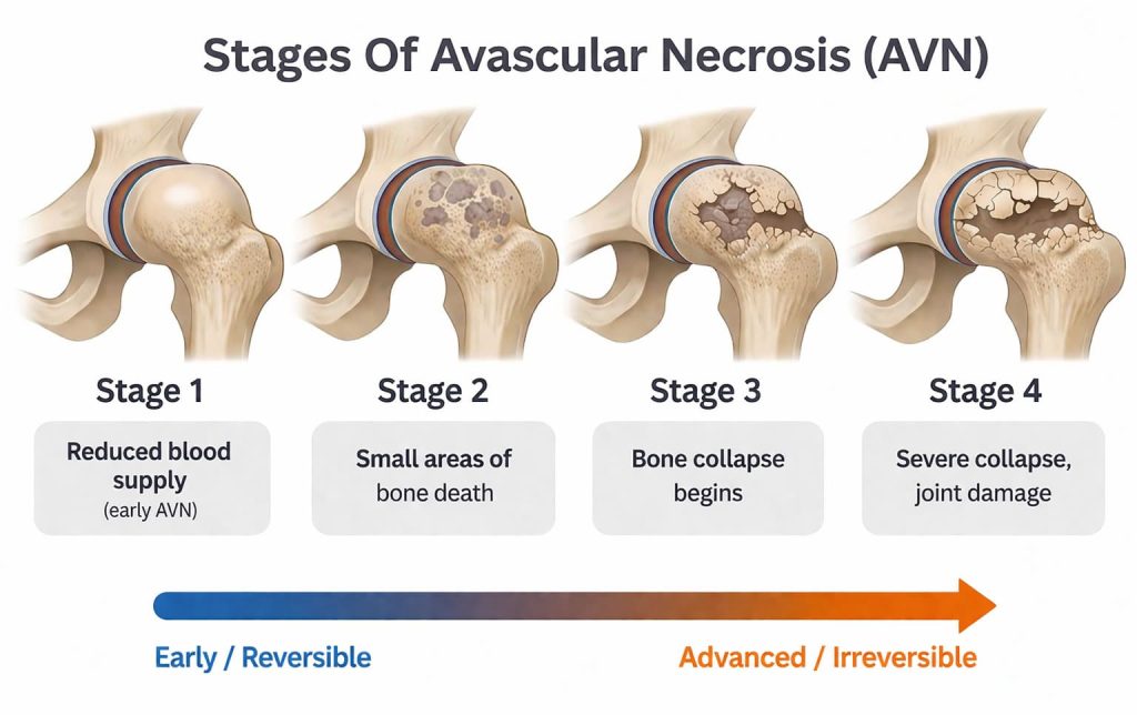 Infographic showing the four stages of avascular necrosis (AVN) of the hip, from early reduced blood supply to severe femoral head collapse and joint damage, with a progression arrow from reversible to irreversible stages.