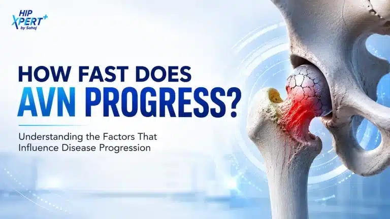 How fast does avascular necrosis (AVN) progress? Medical illustration showing an affected hip joint with AVN.