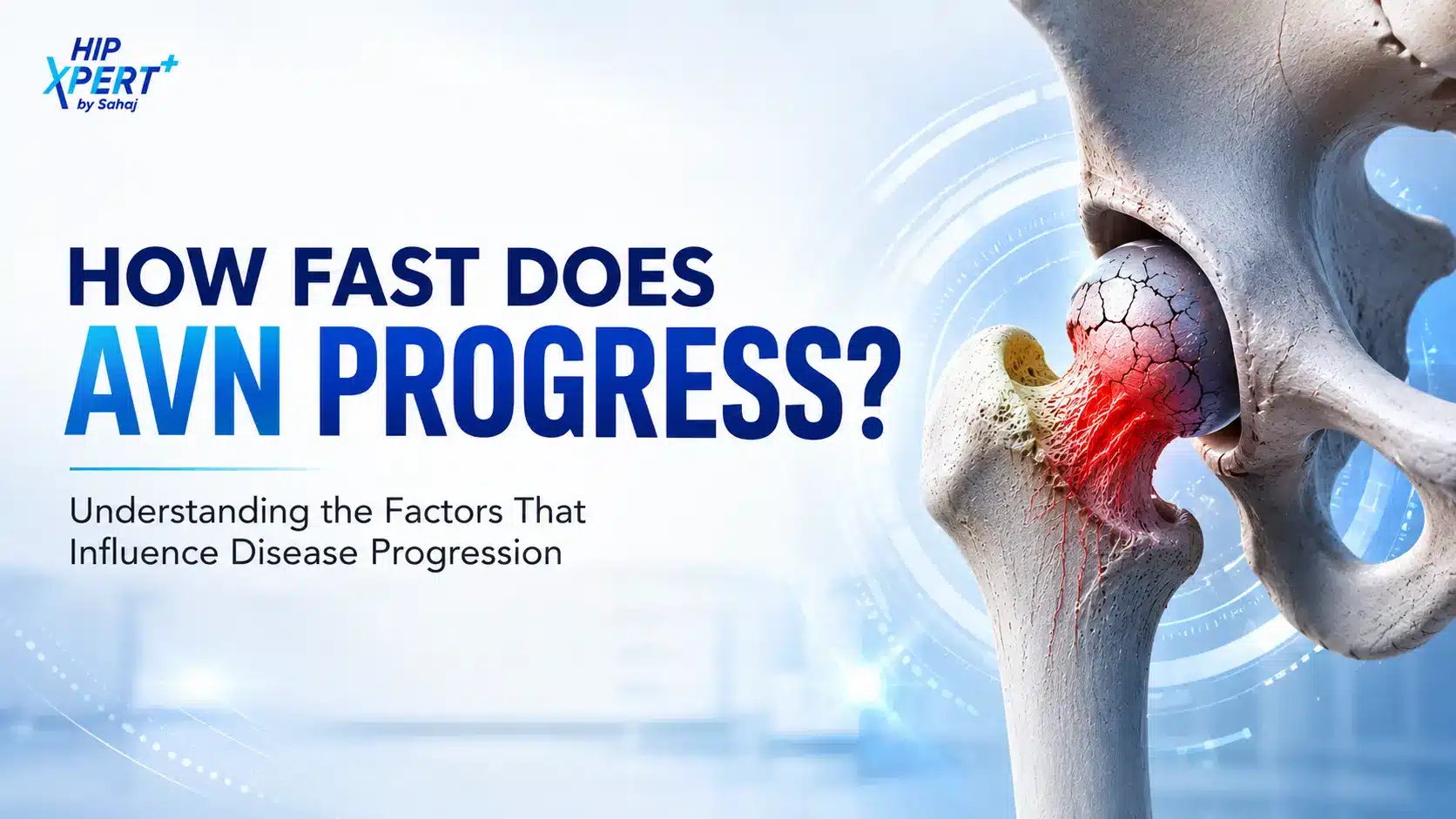 How fast does avascular necrosis (AVN) progress? Medical illustration showing an affected hip joint with AVN.