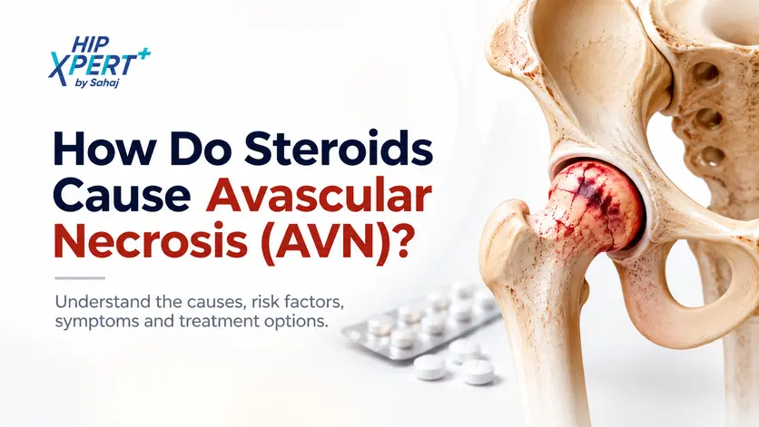 How do steroids cause avascular necrosis (AVN)? Medical illustration of hip bone damage with steroid tablets